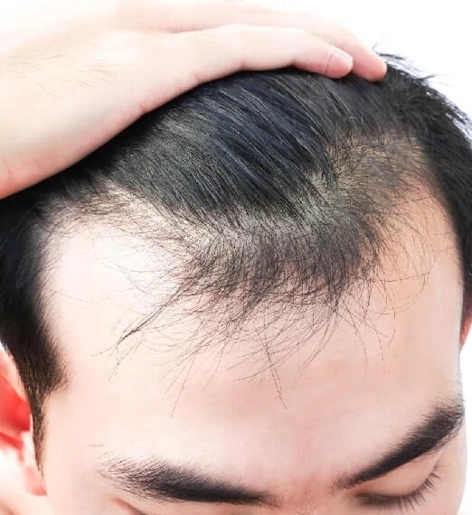 Best PRP Therapy for Hair Loss Treatment in Bangalore