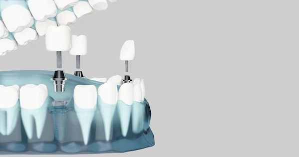 The Long-Term Advantages of Dental Implants in Georgetown, KY
