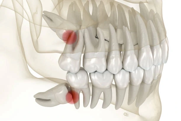 Wisdom Teeth Removal: Signs, Process, and Recovery Tips You Should Know