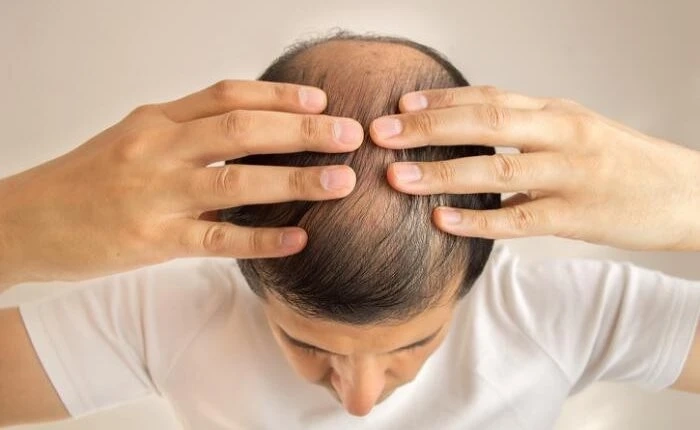How To Get The Best Hair Transplant in Chandigarh?