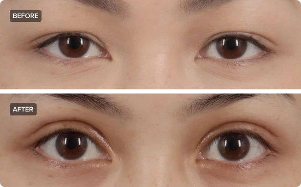 Double Eyelid Surgery: Enhancing Your Natural Beauty