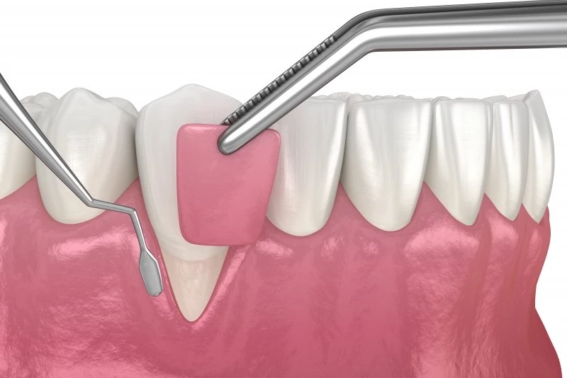 Gum Grafting: Types, Procedure