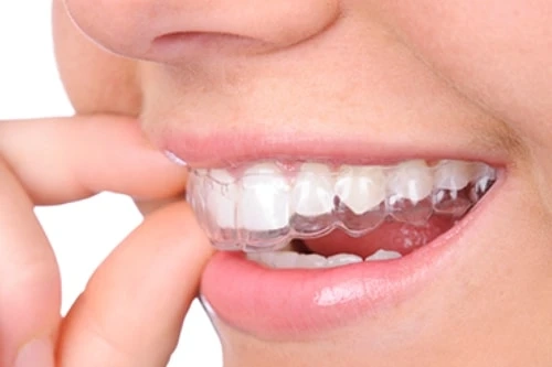 Invisalign in Acworth