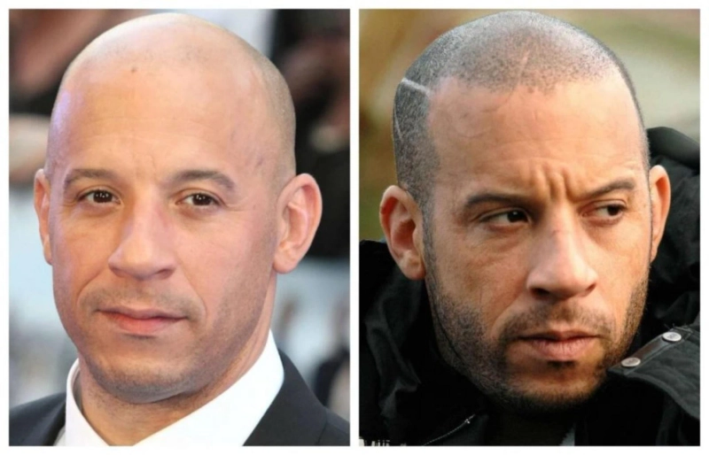 Unveiling the Wonders of Scalp Micropigmentation