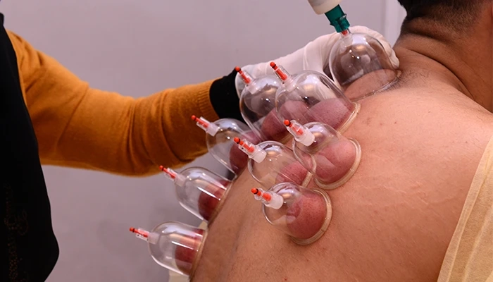 Unveiling Hidden Costs What to Factor In Beyond the Base Price for Hijama in Dubai