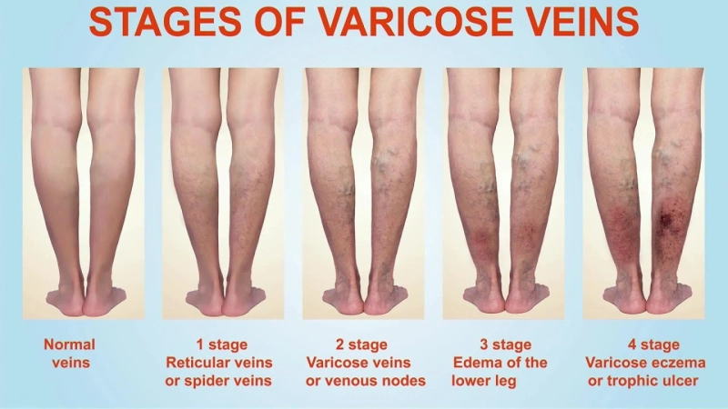8 Effective Ways You Can Manage Varicose Veins