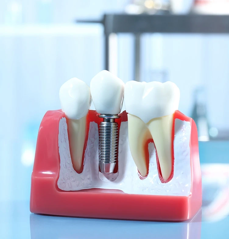 Prednosti zobnih vsadkov za vaš popoln in zdrav nasmeh