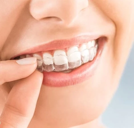 Invisible Orthodontics Market Size and Growth Forecast : Top Manufacturers,Future Developments,Regional Analysis.