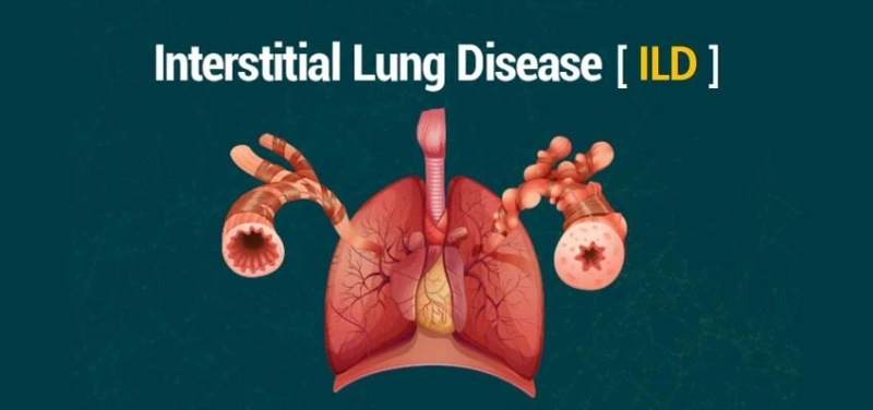 Forecasting 2022-2028: Global Interstitial Lung Disease Market trends, share, size, growth, opportunities, and forecasts