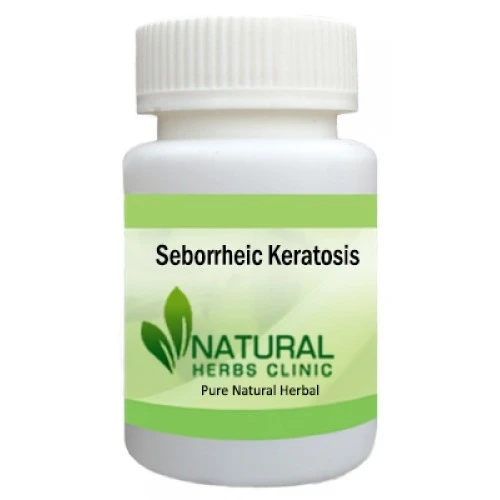 Herbal Treatment for Seborrheic Keratosis - Natural Herbs Clinic