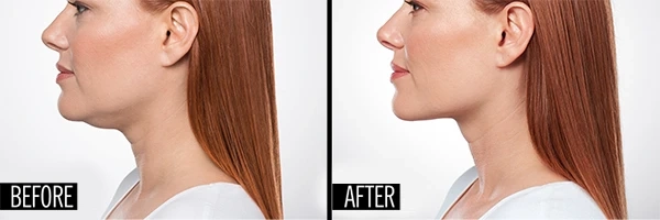 Kybella vs CoolSculpting