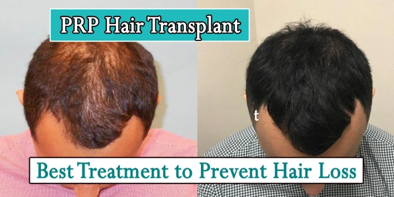 PRP Hair Restoration-Best Treatment to Prevent Hair Loss