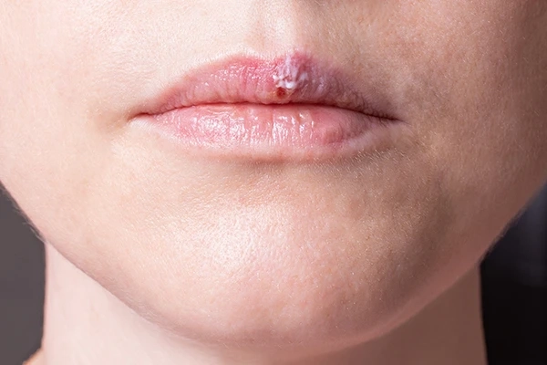 Exploring Different Types of Lip Pimples and Their Treatments