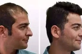 Hair Transplant: The Right Choice For You!