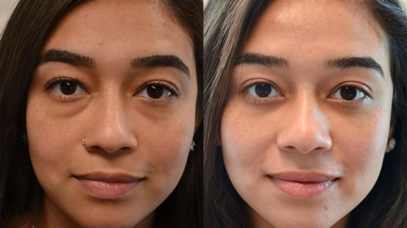 The Complete Guide to Lower Blepharoplasty Cape Town: What to Expect & Why It Works