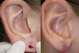 Ear Piercing in Dubai on a Budget Making it Affordable