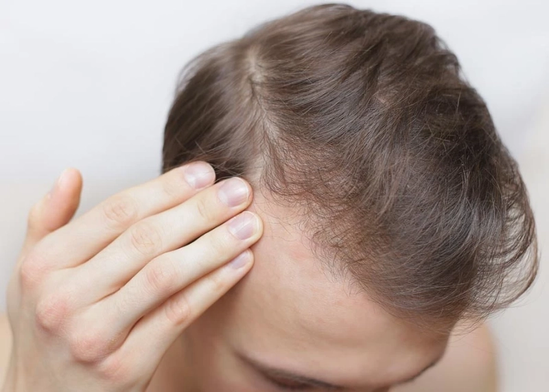 Alopecia Universalis: Living with Total Hair Loss
