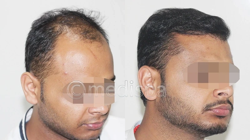 Why is FUT the Preferable Technique for Hair Transplant?