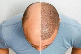  Unlocking Confidence: Hair Transplant Success Stories