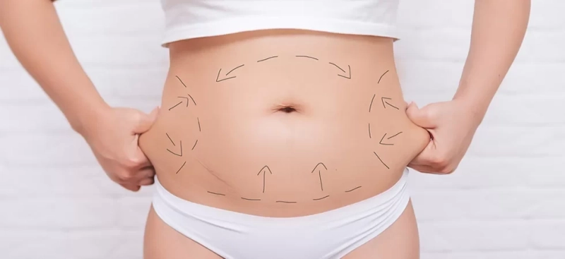 Quality vs. Cost: Affordable Tummy Tuck in Islamabad Explained