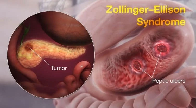 Zollinger-Ellison Syndrome - Symptoms, Causes, and Treatment