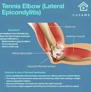 Tennis Elbow Therapy & Treatment at Casamed