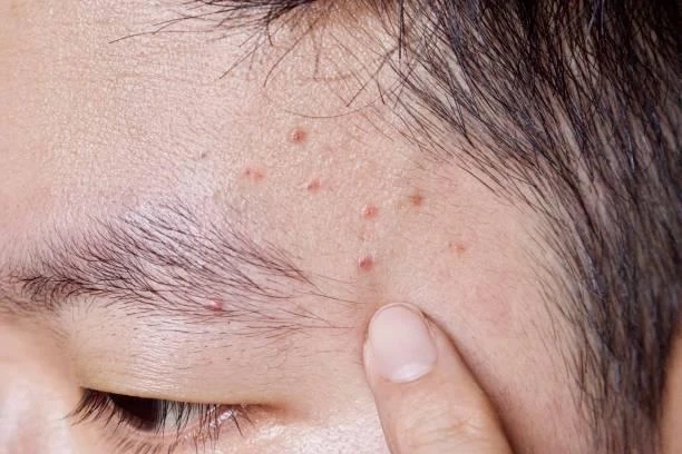 Folliculitis: Causes, Symptoms, and Treatment