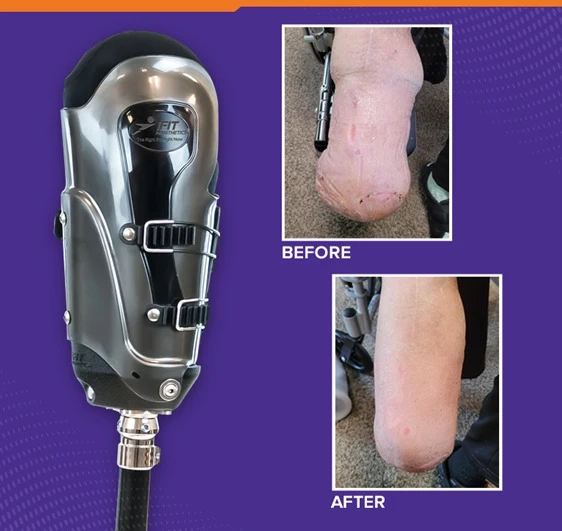IFIT Prosthetics Residual Limb Shaping: Enhancing Comfort and Functionality