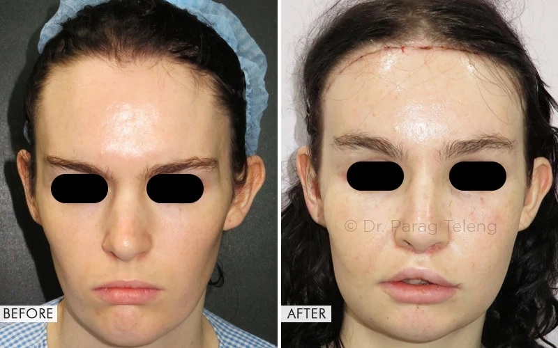 The Most Affordable Facial Feminization Surgery Cost in USA, UK & India