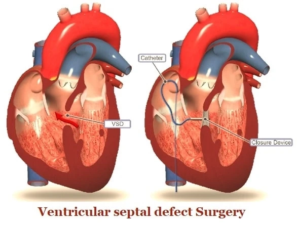 Experience Top-Notch VSD treatment in India With High Success Rate
