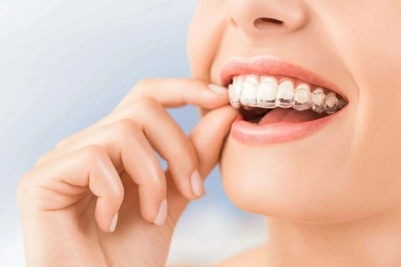 Why Invisible Braces Are the Better Option