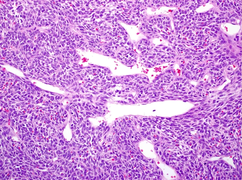 Radiation Therapy for Medical Synovial Sarcoma Treatment: Dosage and Side Effects