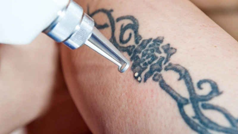 Tattoo No More: The Transformative Power of Laser Technology