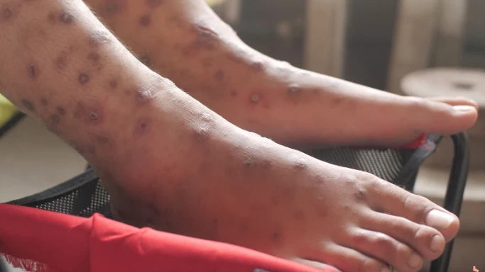 Understanding the 3 Common Types of Leg Ulcers: Venous, Arterial, and Diabetic