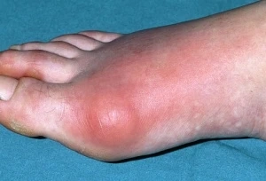 What are the Certain Changes in Lifestyle with Gouty Arthritis?