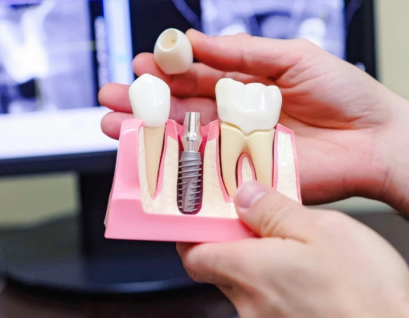 Romania Dental Implants Market Trends, Business Revenue Forecast by 2031