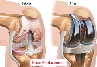 Risks Associated With Postponing Knee Replacement Surgery