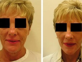 Real Patient Stories: Experiences with Top Facelift Clinics