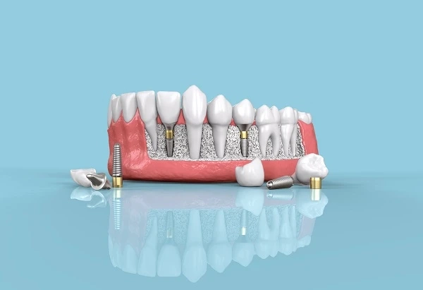 What You Should Know About the Dental Implant Industry