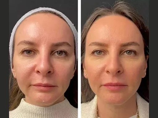 Mesotherapy in Dubai: Expert Consultations