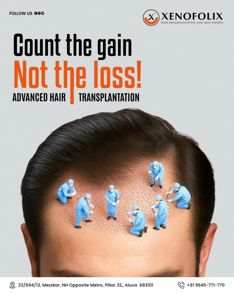 Why Everyone Is Talking About GFC and Exosome Treatments for Hair Loss and What Most People Don’t Know