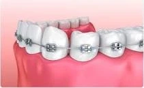 which is the best dental clinic for braces in Hyderabad