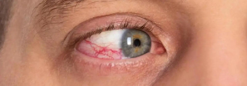 Cornea Damage: Causes, Symptoms, and What Patients Commonly Want to Know