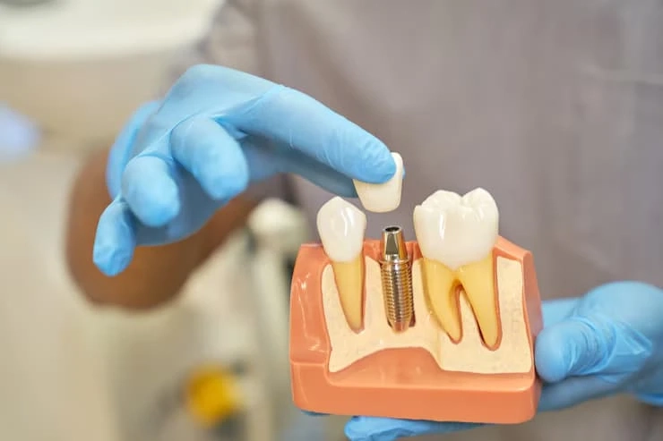 How Much Do Dental Implants Cost in Essex?