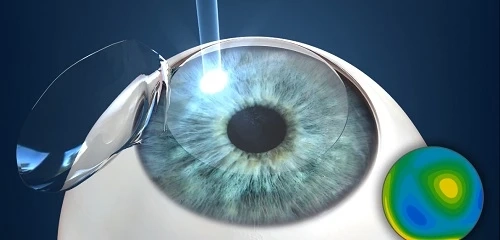 The Benefits and Risks of Custom LASIK Surgery: Is It Right for You?