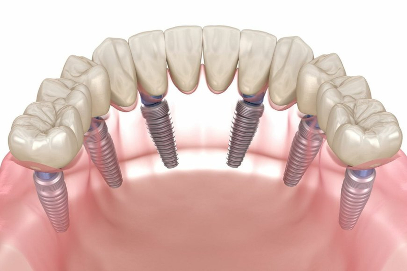 Considering Dental Implants in New York? Should Know About the Process