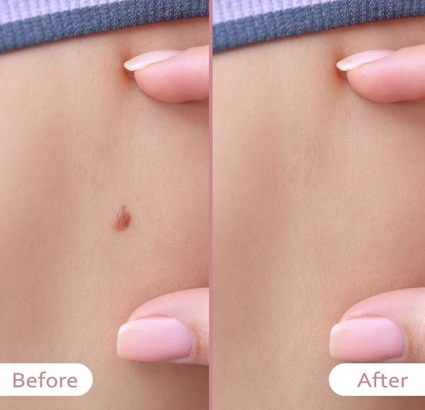 Can Moles Be Removed Permanently?