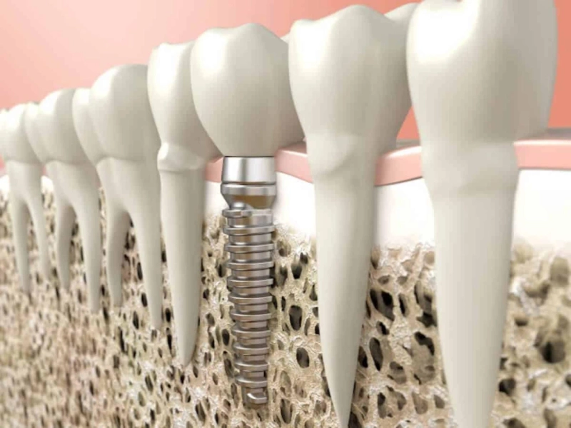 How Have Dental Implants Changed the Dental Industry?