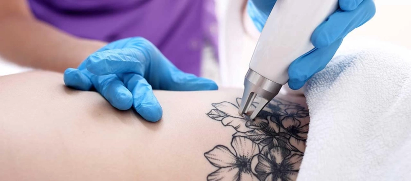 Laser Tattoo Removal for Visible, Long-Lasting, and Safe Skin Renewal Results