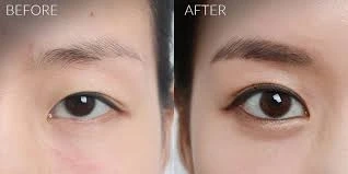 Asian blepharoplasty procedure | Dr. Rajat Gupta